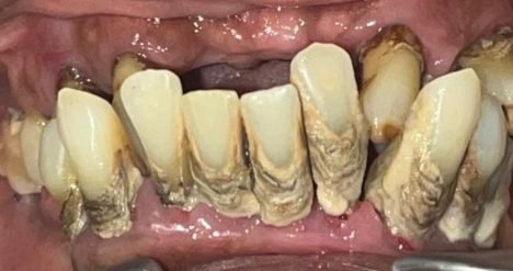 Full mouth dentures before