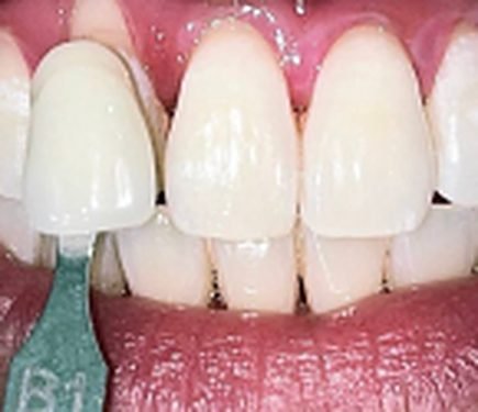 Teeth whitening after