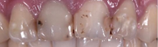 Veneers before