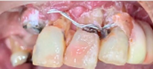 Partial dentures before
