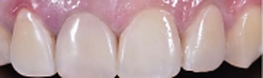 Veneers after