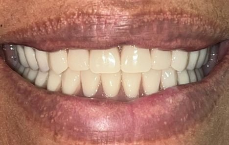 Full mouth dentures after