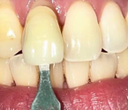Teeth whitening before