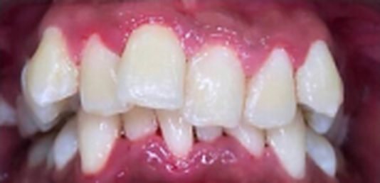 Braces before