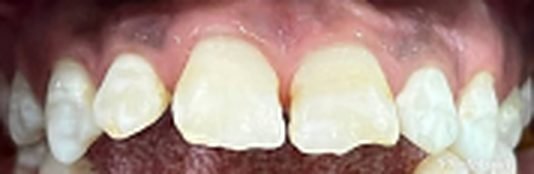 Whitening & ICON after