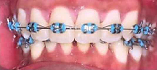 Braces in progress