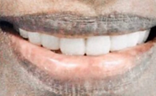 Partial dentures after